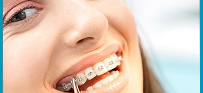 مراقبت از دندان ارتودنسی شده