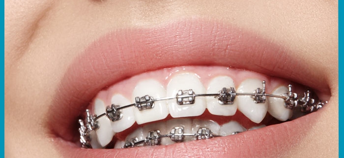 بررسی تأثیر دارو بر سرعت حرکت ارتودنتیک دندان ها بخش دوم