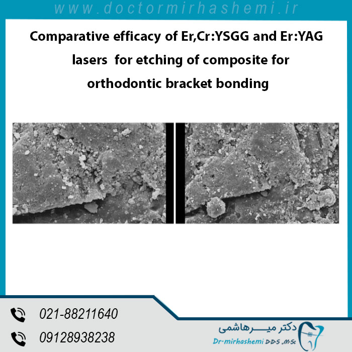 مقایسه لیزرهای Er,Cr:YSGG و Er:YAG برای لایه برداری از براکت های ارتودنسی