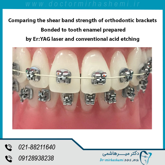 تاثیر روش های متفاوت آماده سازی سطح دندان و یا اچ دندان به وسیله لیزر یا روش های معمولی اسید فسفریک