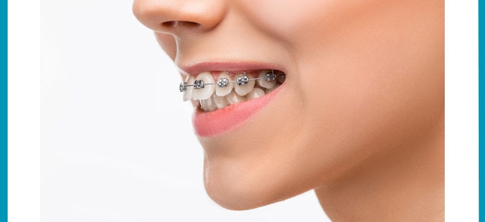تأثیر ذرات نانو اکسید روی و نانو کیتوزان بر مقاومت چسبندگی ترکیبات دندانی