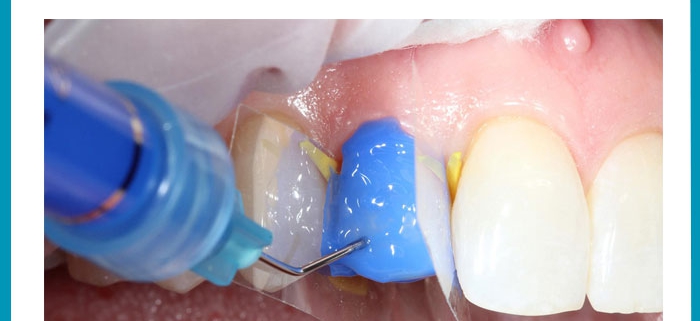 تاثیر درمان سطحی بر ترک های مینای دندان پس از جداسازی براکت ارتودنسی
