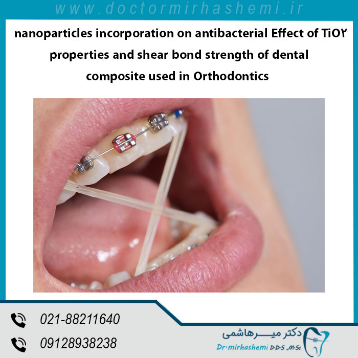 تاثیر ترکیب نانو ذرات TiO2 بر خواص ضد باکتریایی و قدرت چسبندگی کامپوزیت دندانی