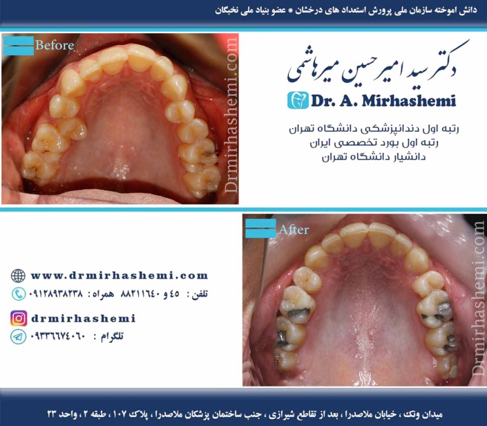 تصاویر درمان انحراف میدلاین دندان