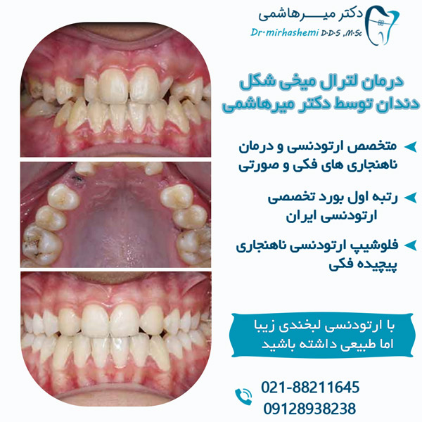 درمان دندان لترال میخی شکل با ارتودنسی