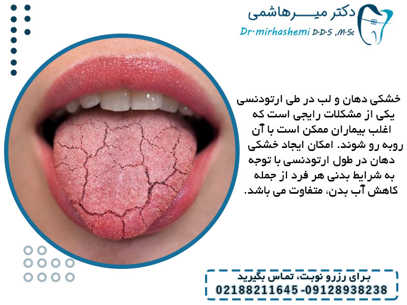 عوامل و علائم مهم خشکی لب و دهان