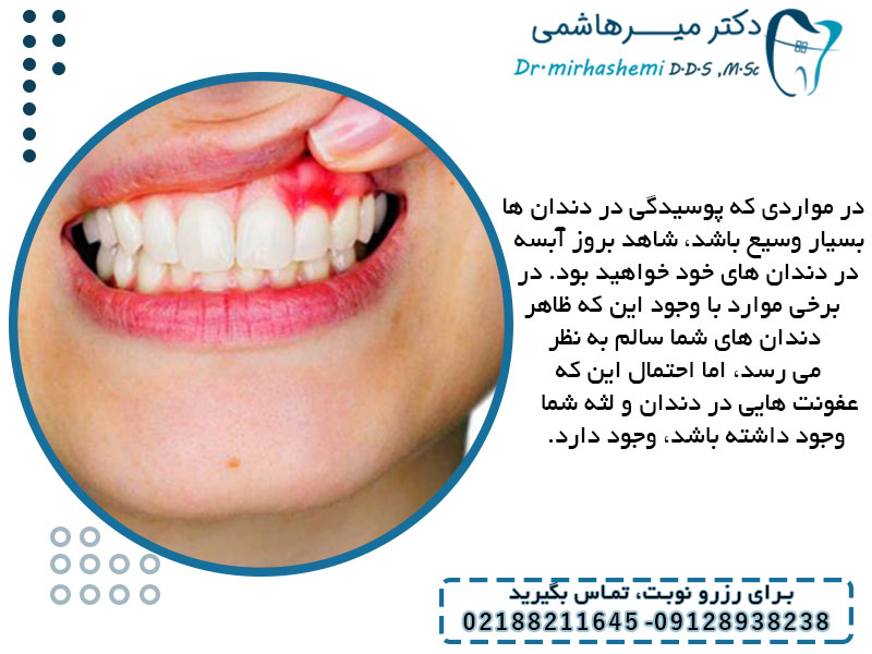 علائم ایجاد عفونت در دندان ها حین درمان ارتودنسی