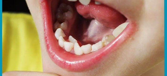 علت رشد دندان های اضافه