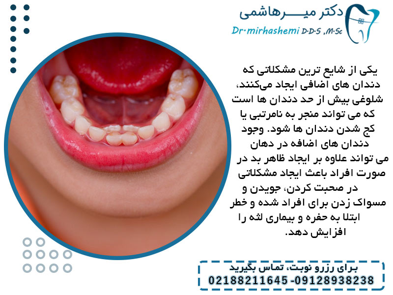 مشکلات ناشی از دندان اضافه در کودکان